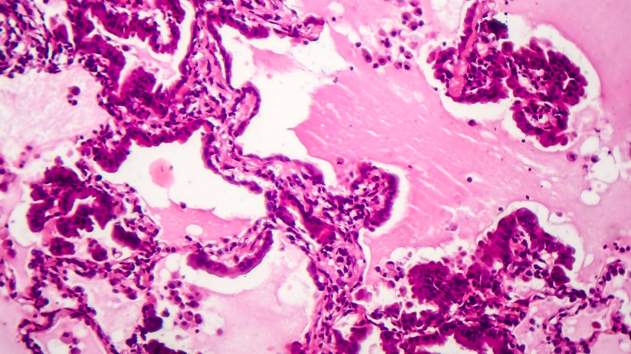 lung cancer in non smoker